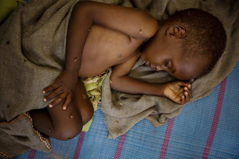 malnutrition diseases